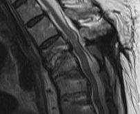 T45 discitis